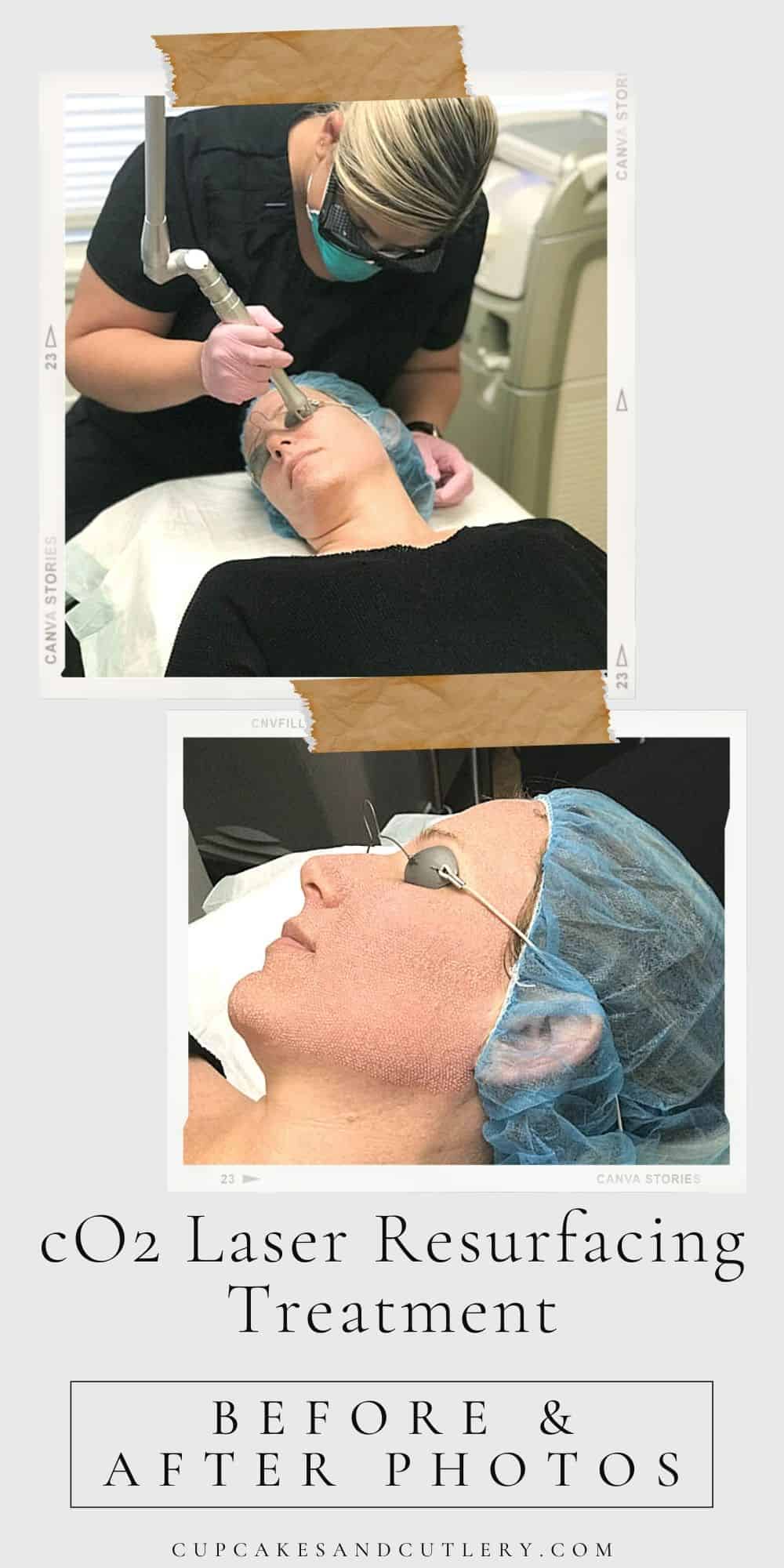 co2-laser-skin-resurfacing-treatment-and-recovery-before-and-after